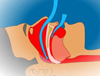 blockage of uppper airway